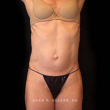 Tummy Tuck Before Image Patient 37 Front View