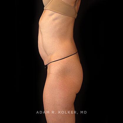 Tummy Tuck Before Image Patient 37 Side View