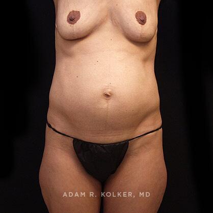 Tummy Tuck Before Image Patient 38 Front View