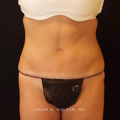 Tummy Tuck After Image Patient 39 Front View