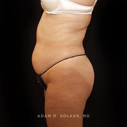Tummy Tuck Before Image Patient 41 Side View