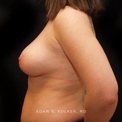 Breast Asymmetry After Image Patient 02 Side View