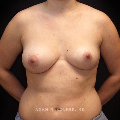 Breast Asymmetry Before Image Patient 06 Front View