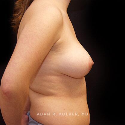 Breast Asymmetry Before Image Patient 06 Side View