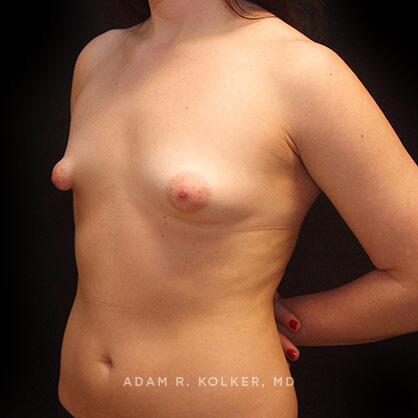 Breast Asymmetry Before Image Patient 07 Oblique View