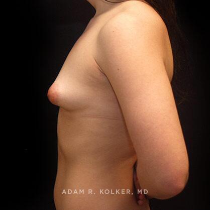 Breast Asymmetry Before Image Patient 07 Side View