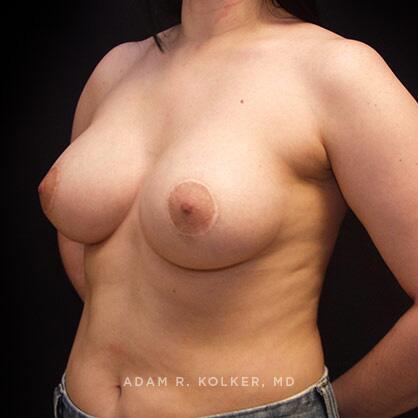 Breast Asymmetry After Image Patient 08 Oblique View