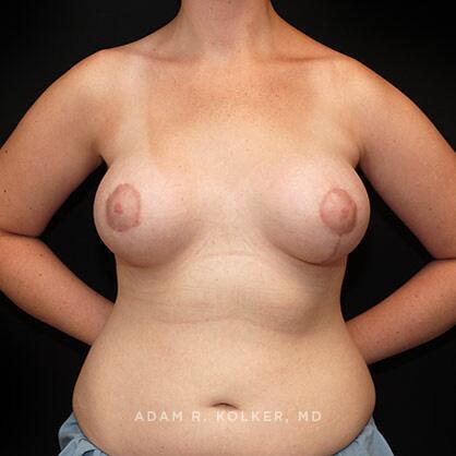 Breast Asymmetry After Image Patient 09 Front View