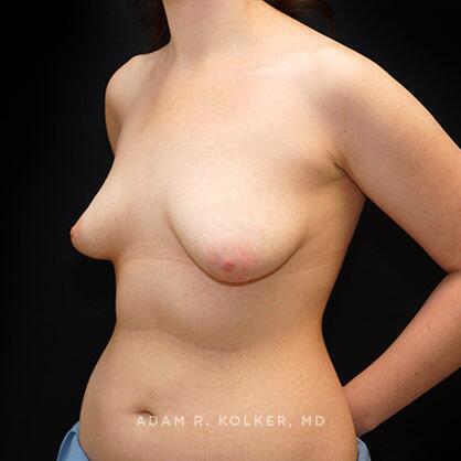 Breast Asymmetry Before Image Patient 09 Oblique View