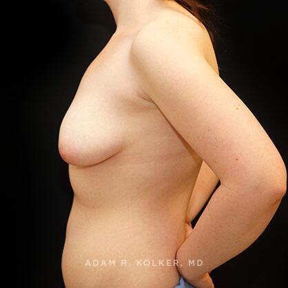 Breast Asymmetry Before Image Patient 09 Side View