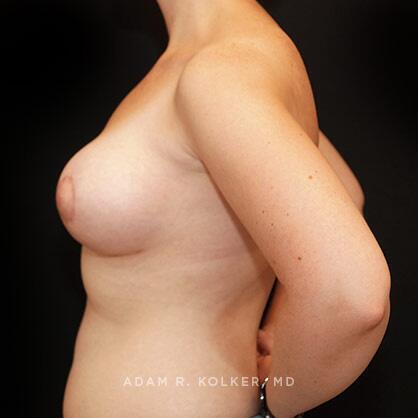 Breast Asymmetry After Image Patient 09 Side View