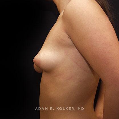 Breast Asymmetry Before Image Patient 10 Side View