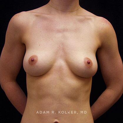 Breast Augmentation Before Image Patient 01 Front View