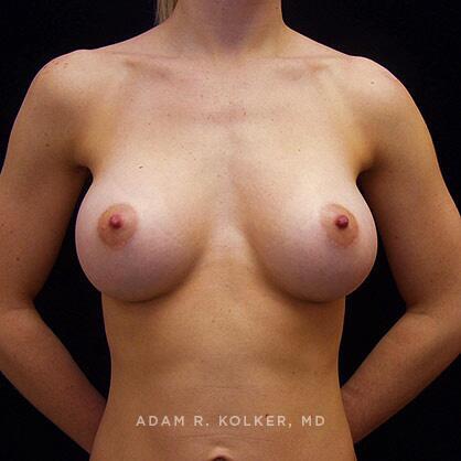 Breast Augmentation After Image Patient 01 Front View