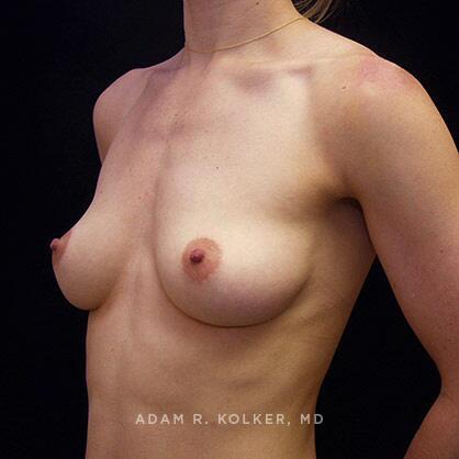 Breast Augmentation Before Image Patient 01 Oblique View