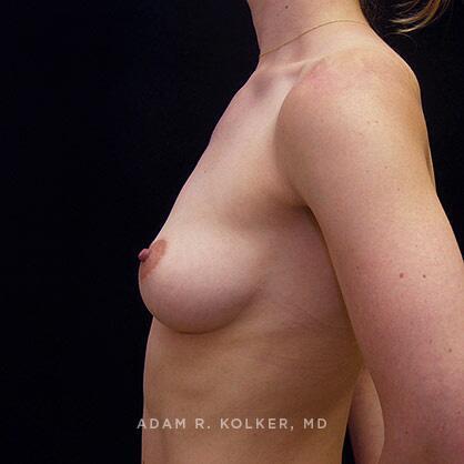 Breast Augmentation Before Image Patient 01 Side View