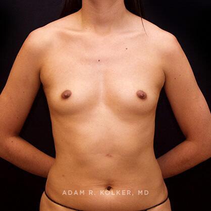 Breast Augmentation Before Image Patient 03 Front View