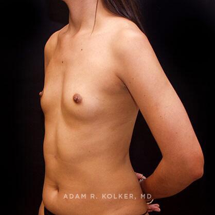 Breast Augmentation Before Image Patient 03 Oblique View