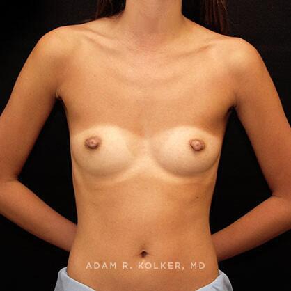 Breast Augmentation Before Image Patient 04 Front View