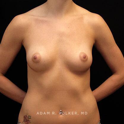 Breast Augmentation Before Image Patient 06 Front View