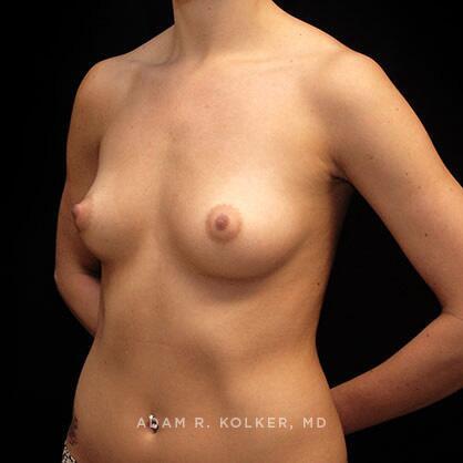Breast Augmentation Before Image Patient 06 Oblique View