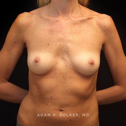 Breast Augmentation Before Image Patient 07 Front View