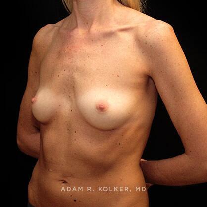 Breast Augmentation Before Image Patient 07 Oblique View