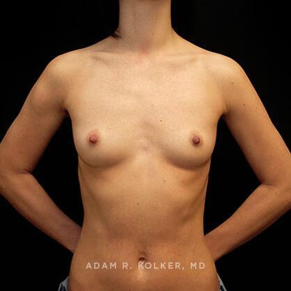 Breast Augmentation Before Image Patient 10 Front View