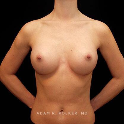 Breast Augmentation After Image Patient 10 Front View