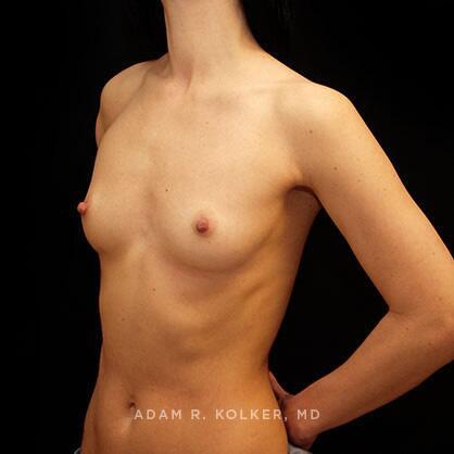 Breast Augmentation Before Image Patient 10 Oblique View