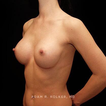 Breast Augmentation After Image Patient 10 Oblique View