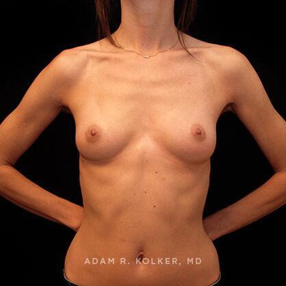Breast Augmentation Before Image Patient 11 Front View