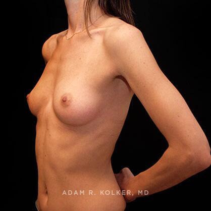 Breast Augmentation Before Image Patient 11 Oblique View