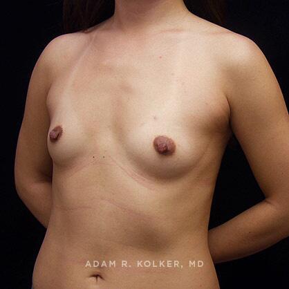 Breast Augmentation Before Image Patient 12 Oblique View