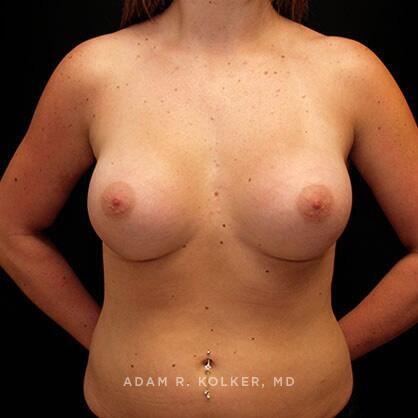 Breast Augmentation After Image Patient 14 Front View