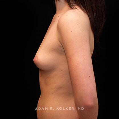 Breast Augmentation Before Image Patient 14 Side View