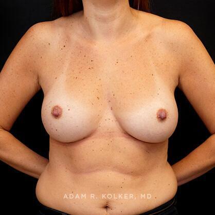 Breast Augmentation After Image Patient 15 Front View