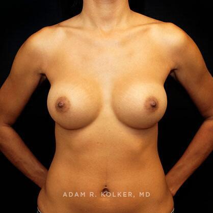 Breast Augmentation After Image Patient 16 Front View