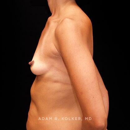 Breast Augmentation Before Image Patient 17 Side View