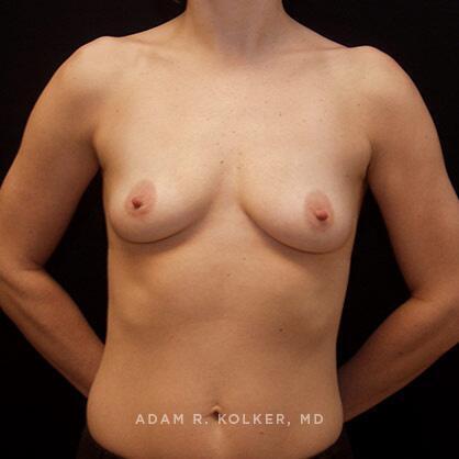 Breast Augmentation Before Image Patient 18 Front View
