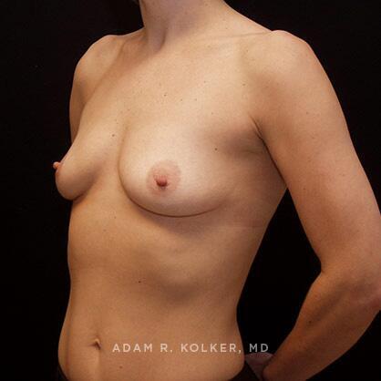 Breast Augmentation Before Image Patient 18 Oblique View