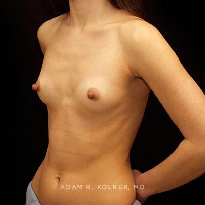 Breast Augmentation Before Image Patient 19 Oblique View