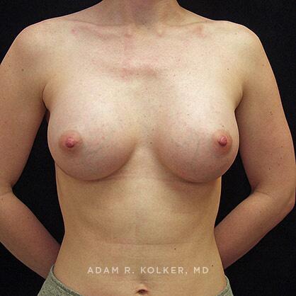 Breast Augmentation After Image Patient 20 Front View