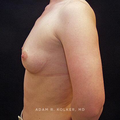 Breast Augmentation Before Image Patient 20 Side View