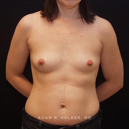 Breast Augmentation Before Image Patient 21 Front View