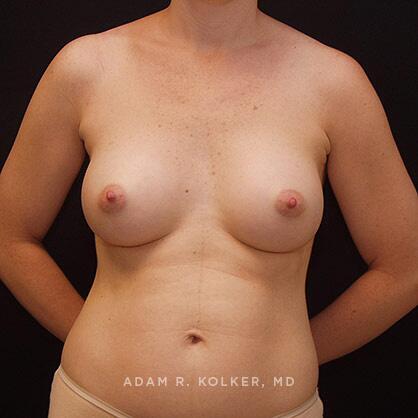 Breast Augmentation After Image Patient 21 Front View