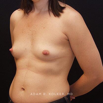 Breast Augmentation Before Image Patient 21 Oblique View