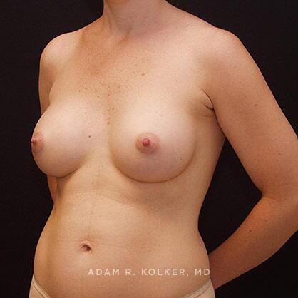 Breast Augmentation After Image Patient 21 Oblique View