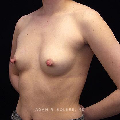 Breast Augmentation Before Image Patient 22 Oblique View
