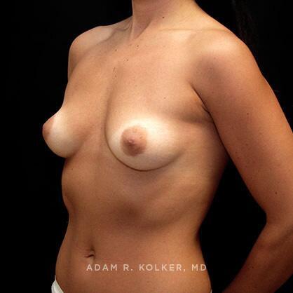 Breast Augmentation Before Image Patient 24 Oblique View